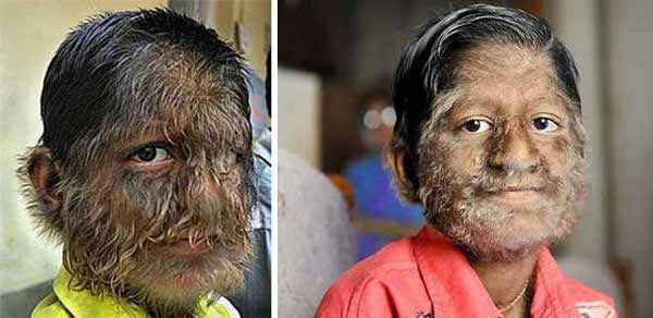 9-hypertrichosis